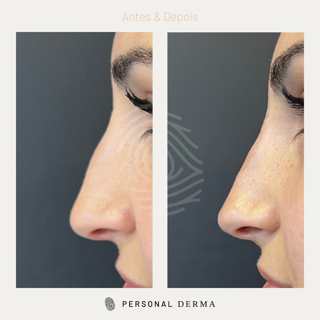 NOVA IMG – Personal Derma_curso rinomodelação_antes e depois #5