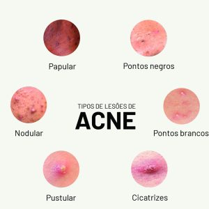 tipos de acne